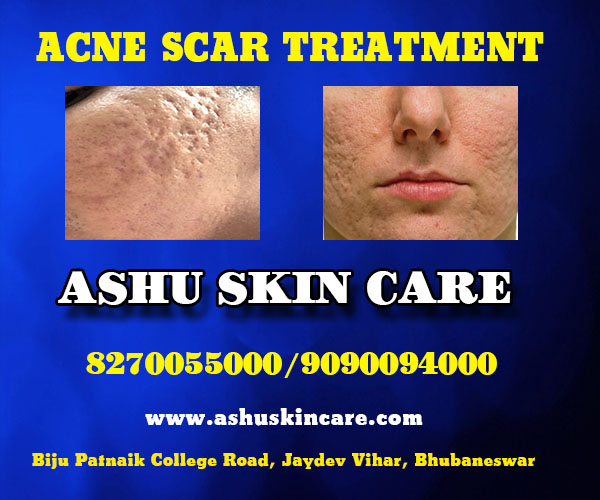 best acne scar treatment clinic in bhubaneswar near sum  hospital